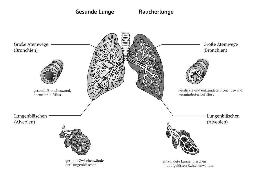 A smoker’s lung is identifiable on first glance